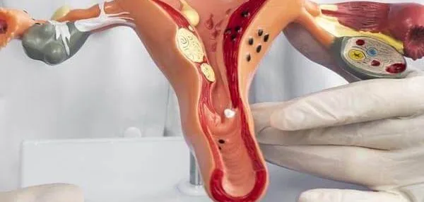 Endometriosis