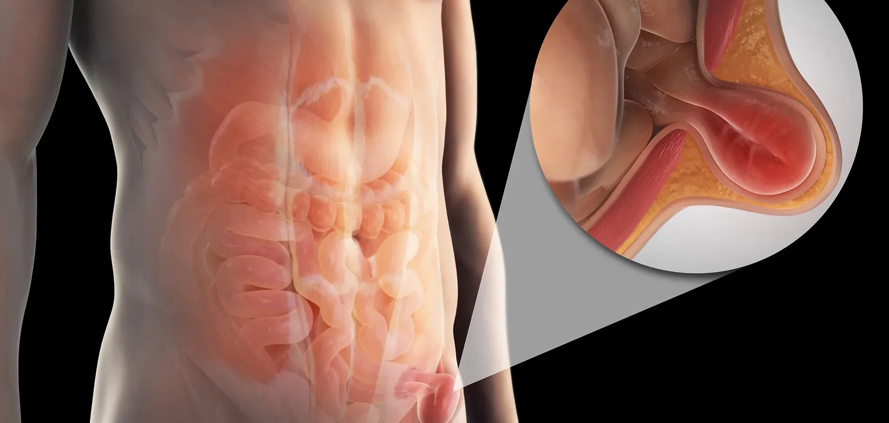 Hernia