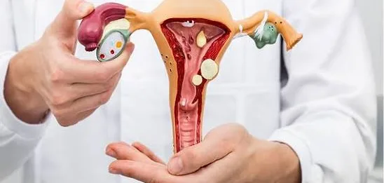 Miom Uterus