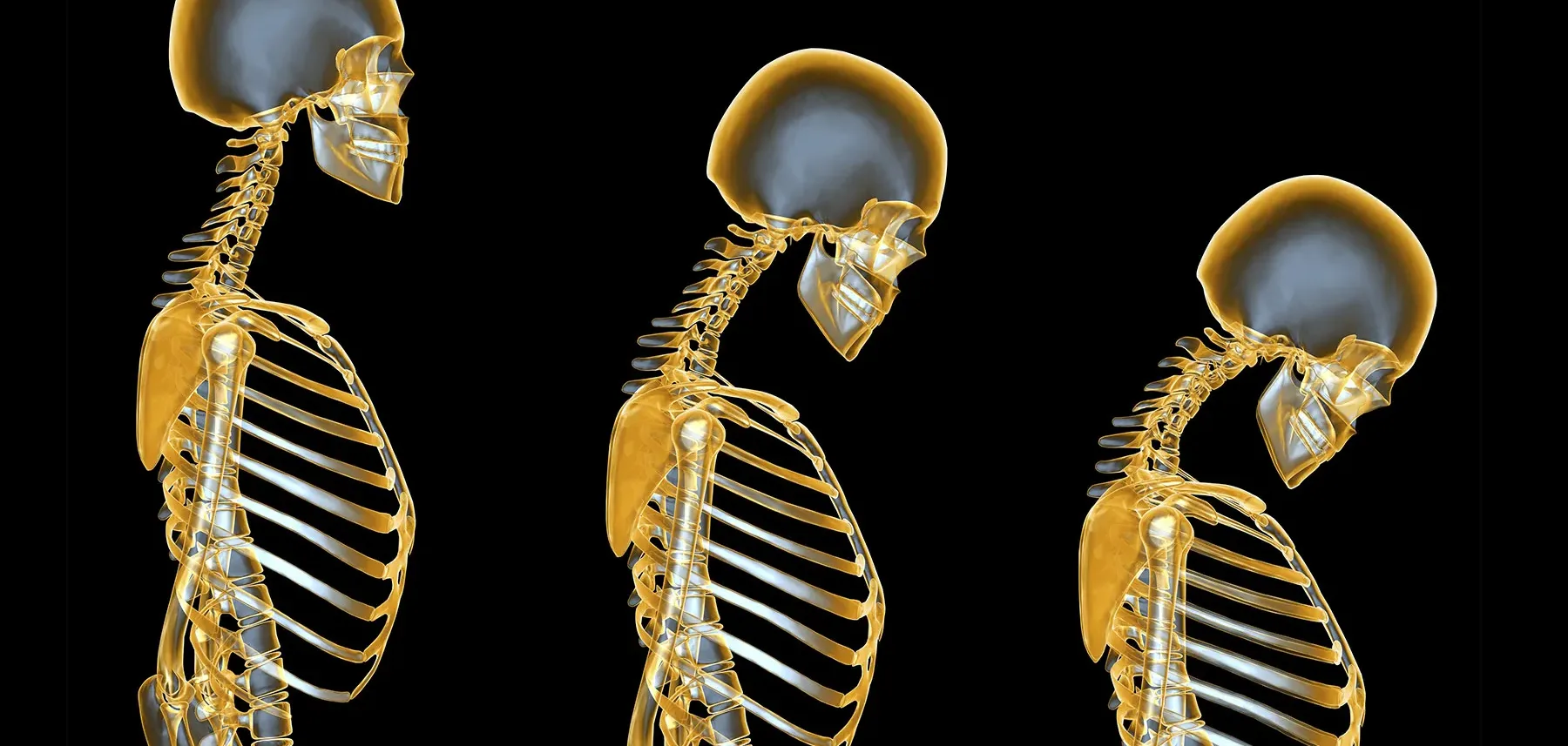 Osteoporosis