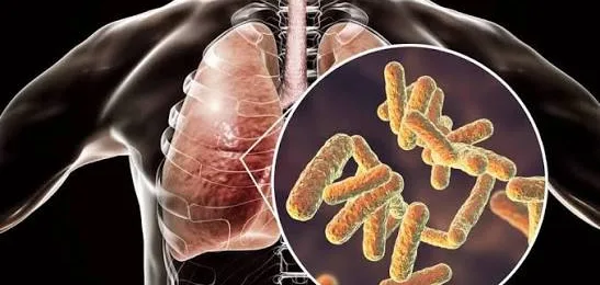 Pneumonia (Radang Paru)