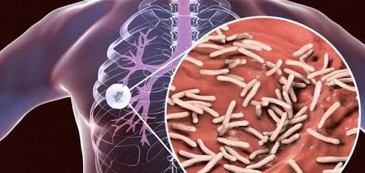 Tuberkulosis (TBC)